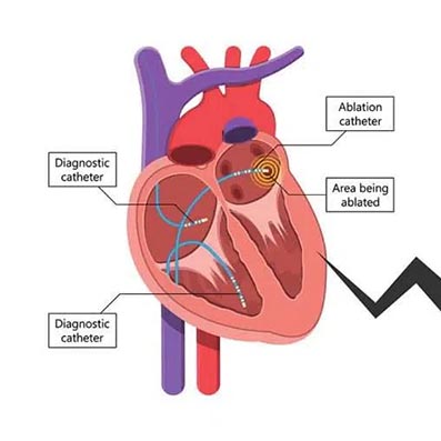 Catheter Ablation overview Joburg South Arrhythmia Centre Home