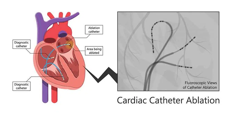 Catheter Ablation Joburg South Arrhythmia Centre Catheter Ablation