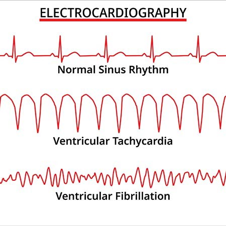 Ventricular Tachycardia Care overview Joburg South Arrhythmia Centre Home
