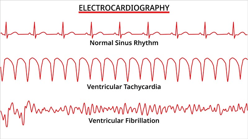 Ventricular Tachycardia Care Joburg South Arrhythmia Centre Ventricular Tachycardia Care